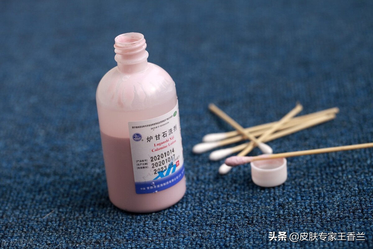 炉甘石洗剂治疗糖尿病皮肤瘙痒,炉甘石洗剂对皮肤瘙痒有效果吗