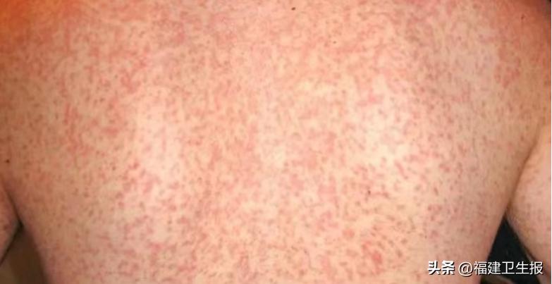 阳了后浑身痒、起疹子？医生提醒：分清类型再治疗