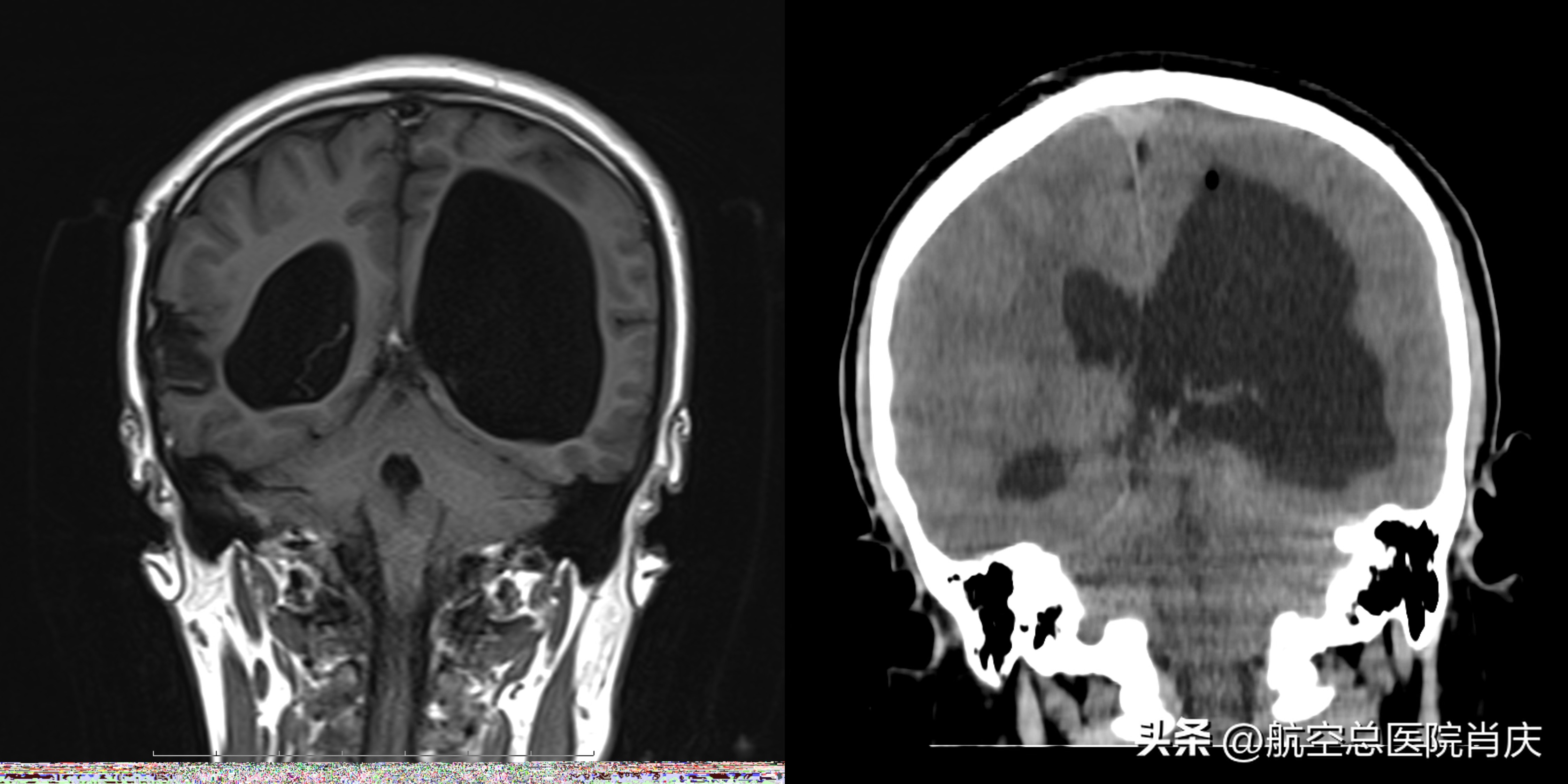 脑积水手术治疗方法最普遍,脑积水的微创治疗