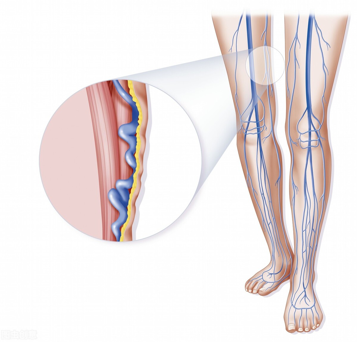 下肢肿胀警惕深静脉血栓形成,下肢静脉血栓看心血管内科