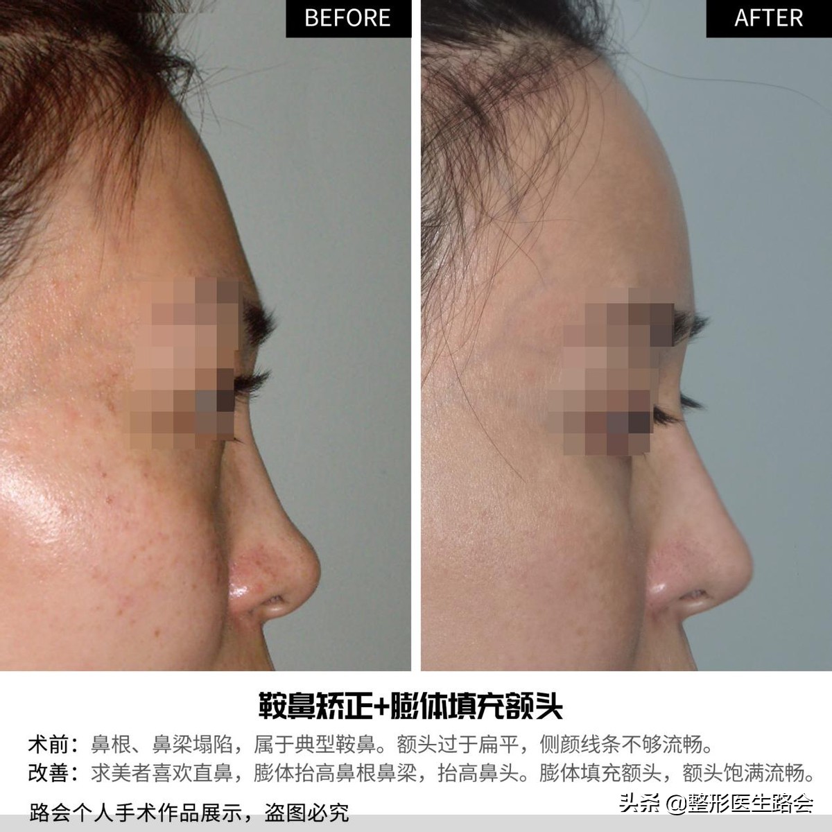 自体脂肪丰额头的危险,自体脂肪和膨体