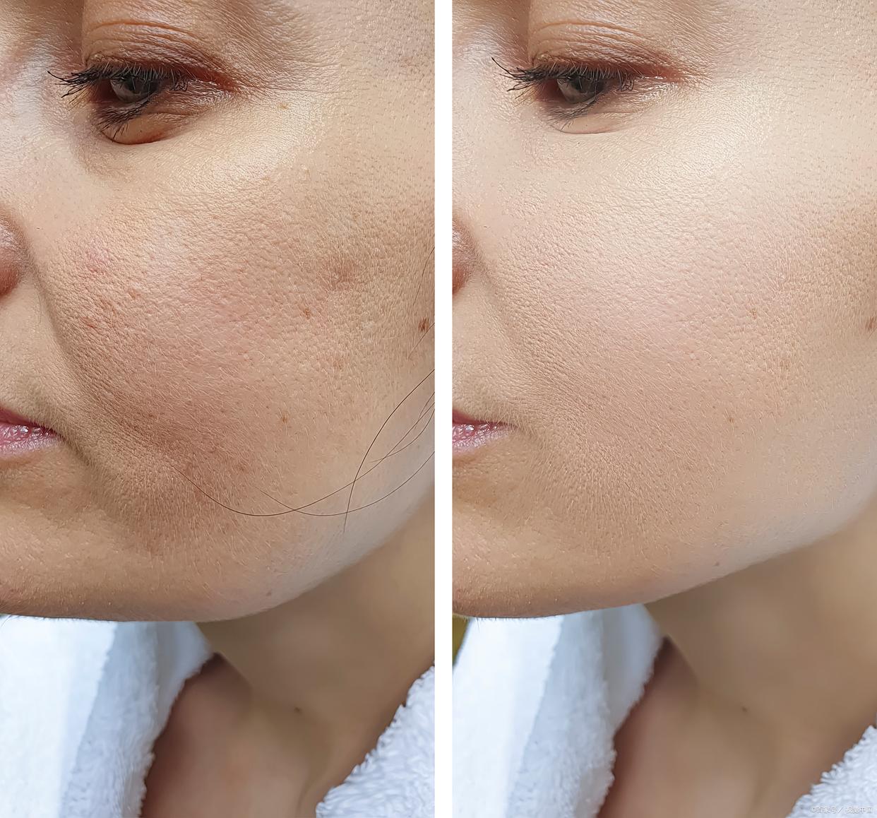 自己怎么改善毛孔粗大缩小毛孔,有痘痘毛孔粗大怎样缩小毛孔