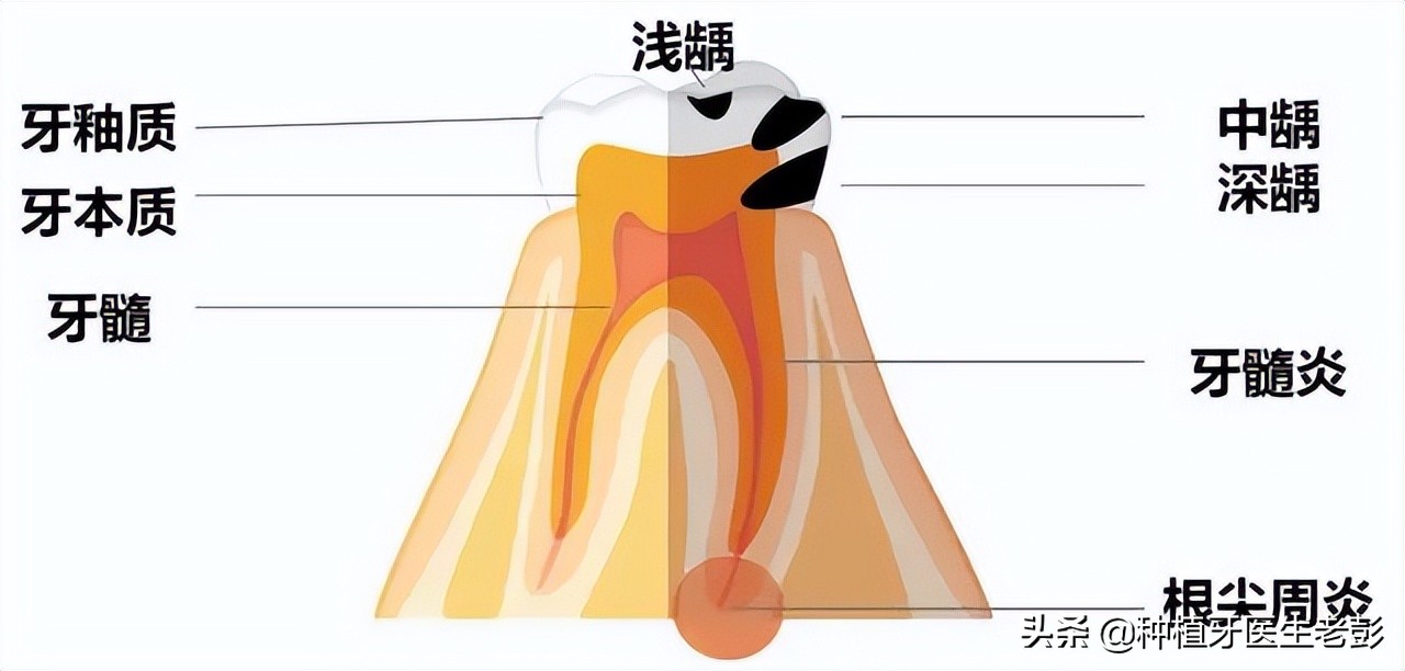 为什么会有蛀牙的解释,为什么会蛀牙是真的有虫吗