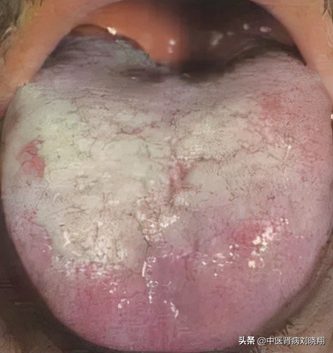 刘主任让病人伸舌头，看的是什么？