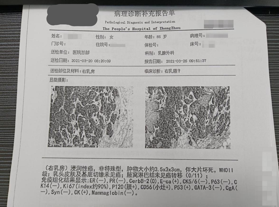 三阴性乳腺癌早期活了10年,年轻人得三阴性乳腺癌