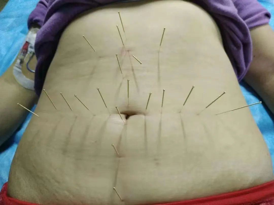 功能性便秘的原因和治疗方法,中医对功能性便秘有办法吗