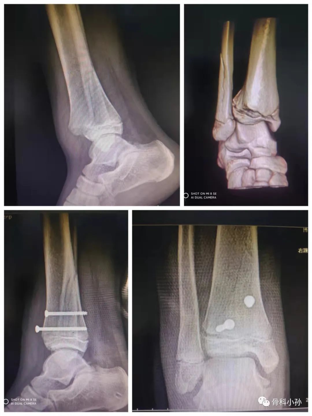 小孩疑似骨折怎么处理,孩子不小心摔伤怎么教
