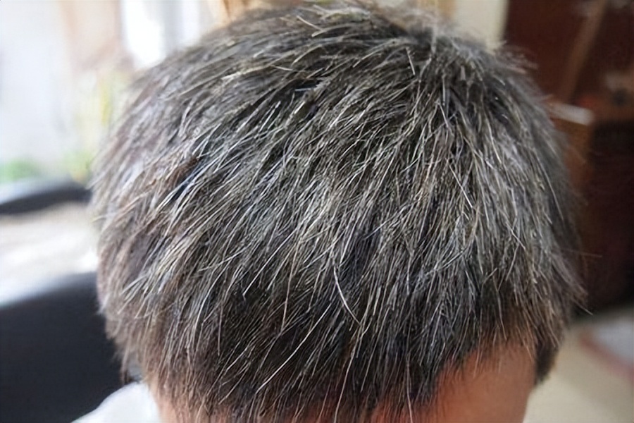 肝肾阴虚须发早白中医怎么治,精血不足须发早白辨治秘方