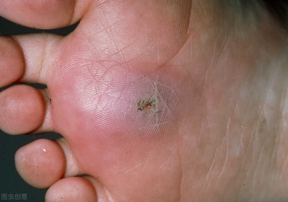 给铁钉刮破皮得破伤风几率,手指被铁钉扎一下破伤风概率多大