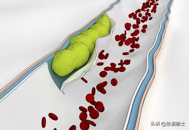 日吞300微塑料，未出生就已被毒害！怎么办？新研究可清除微塑料