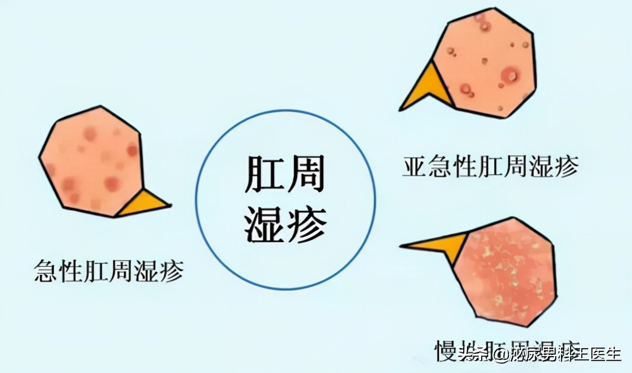 肛门潮湿发痒且有分泌物怎么处理,肛门潮湿发痒是什么病