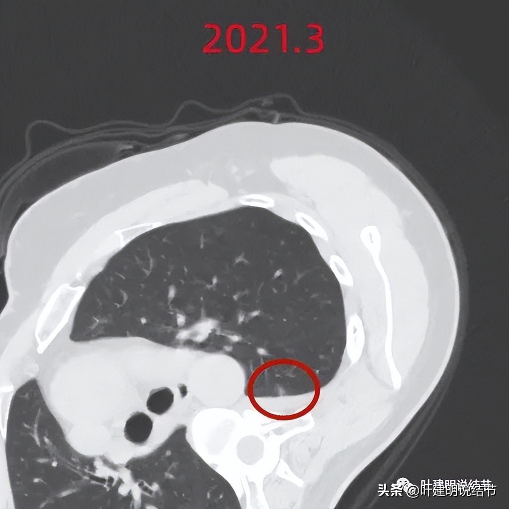 病例分享：这种样子的错构瘤？我是第一次见