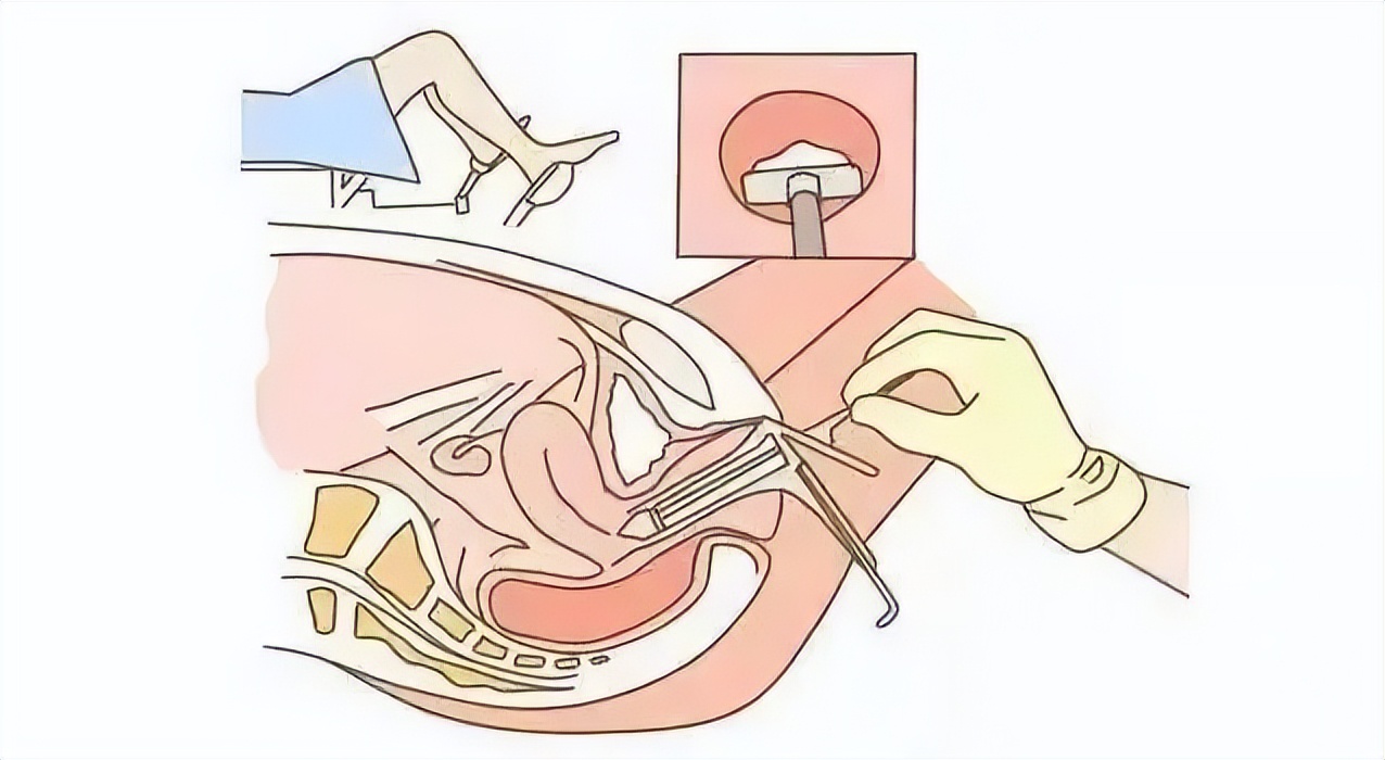 女人有必要每年妇科检查,呵护女性健康体检
