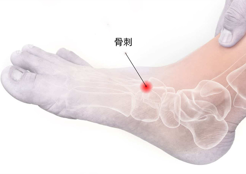 脚背骨质增生疼痛警惕四种病,脚背疼痛是什么原因引起的