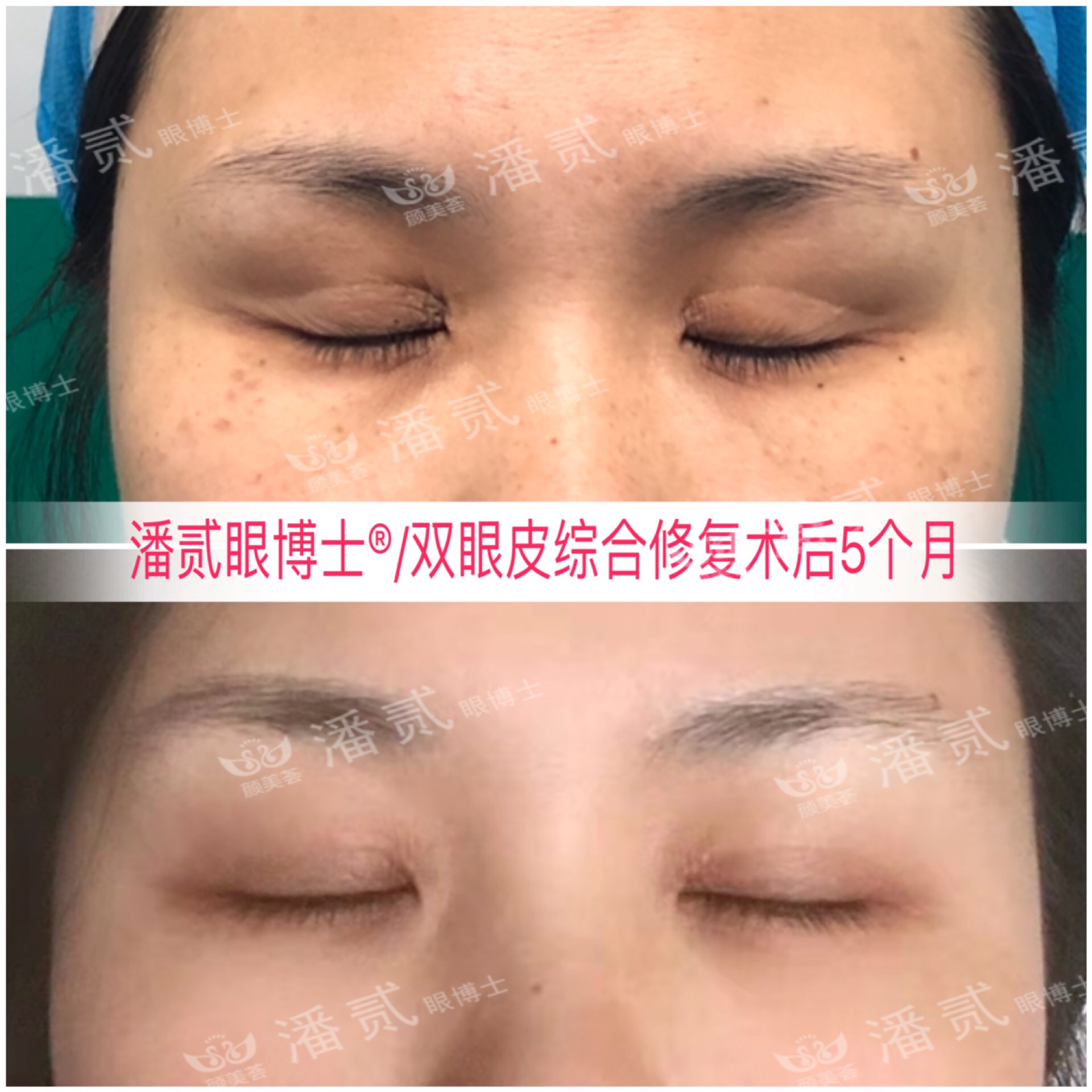 东莞整形做双眼皮,东莞整形医院割双眼皮