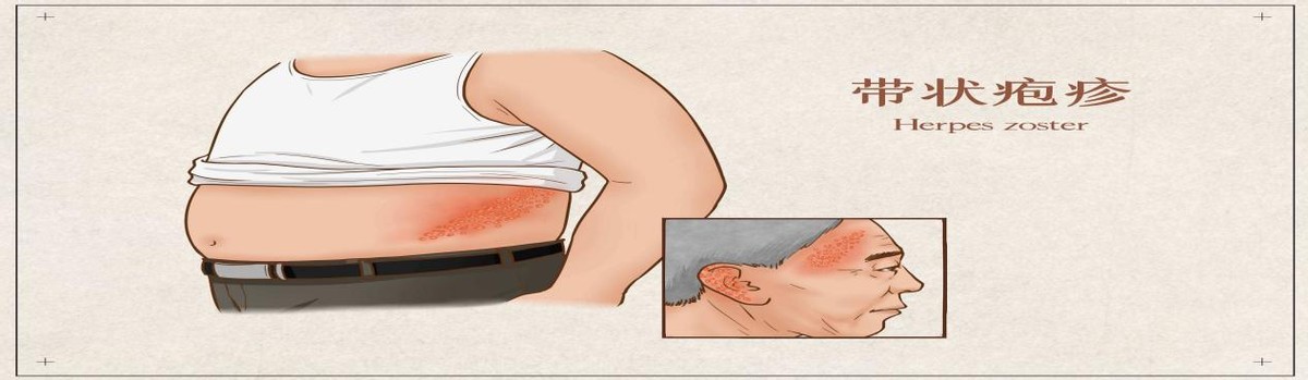得了带状疱疹的是终身的吗,得了带状疱疹的患者会自愈吗