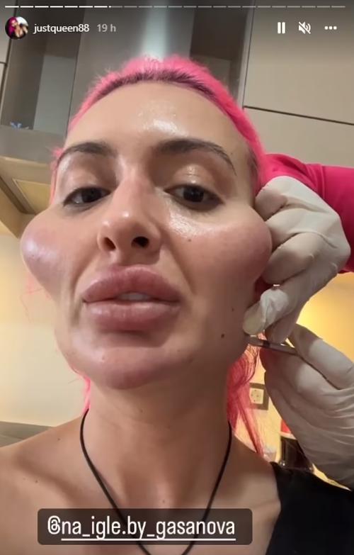 这个动手术打造世界最高颧骨的女人，再次向自己的颧骨下手了