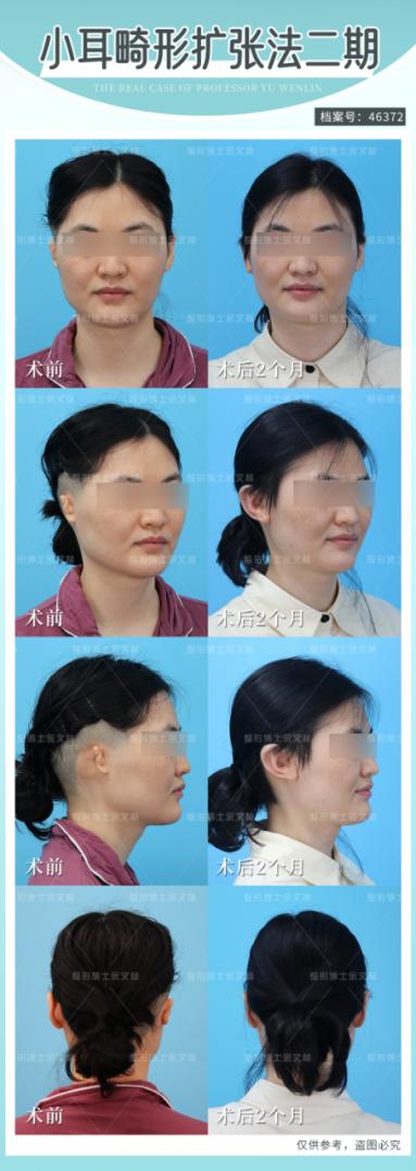 耳再造扩张法这么好，为什么不少小耳畸形患者依然选择直埋法？