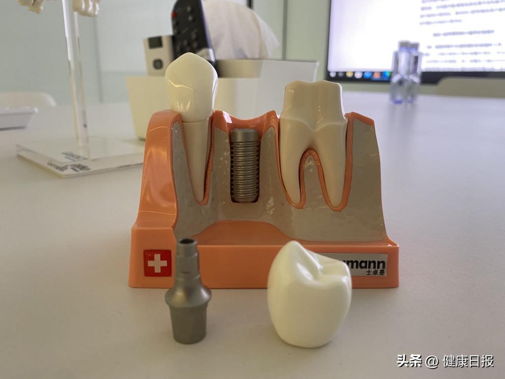 国家医保局谈种牙,种牙医保新政策报销比例