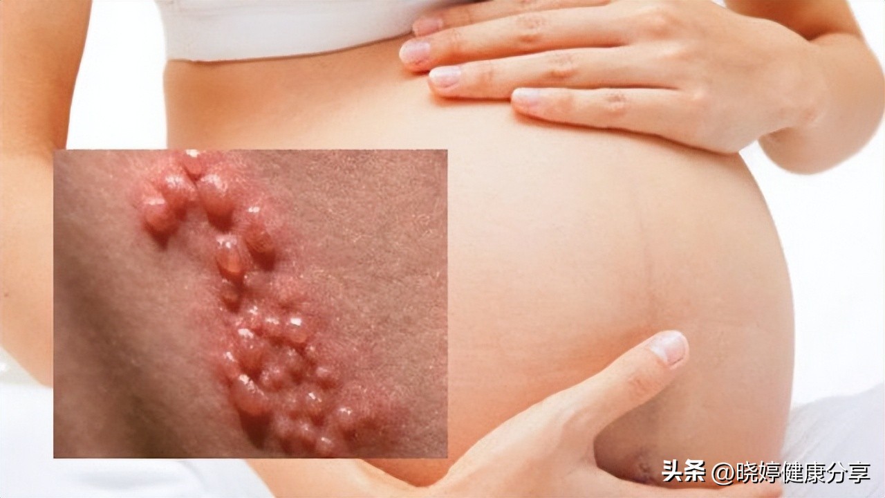 孕妇感染淋病会传染胎儿吗,孕妇感染淋病明显症状