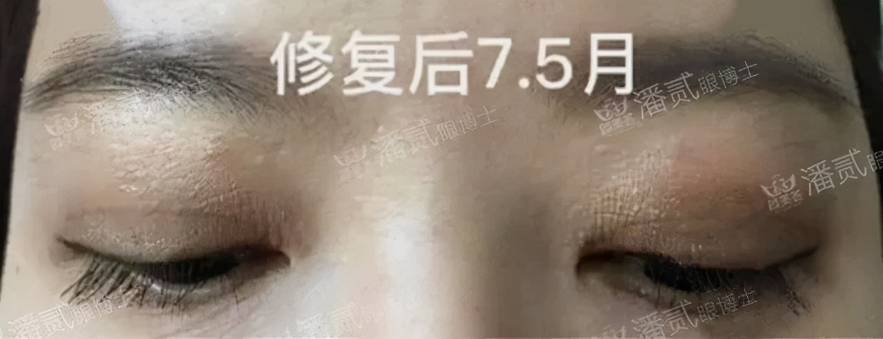 全切双眼皮术后下唇出现多层褶皱,为什么双眼皮术后反而遮瞳孔了