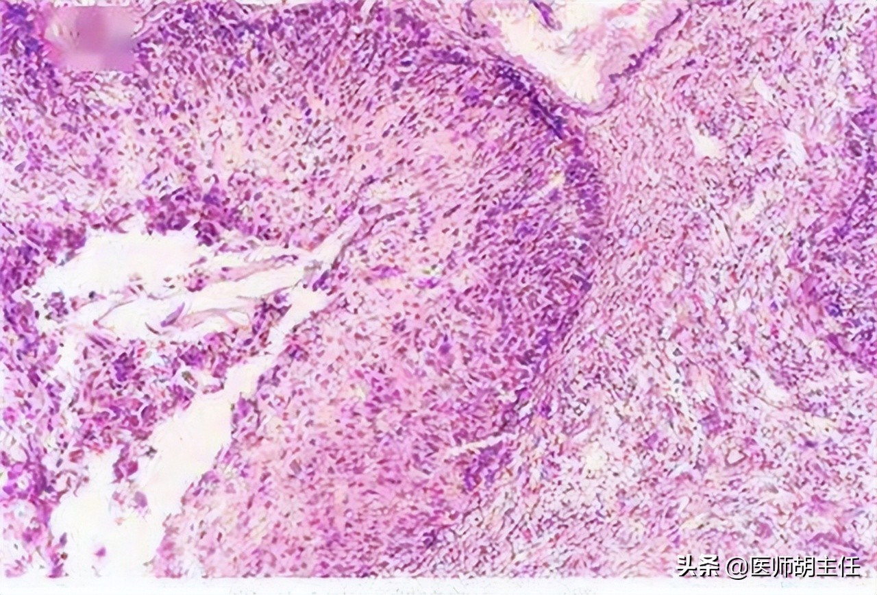 30岁腿痛查出宫颈癌案例,宫颈癌晚期腿上4个信号提示