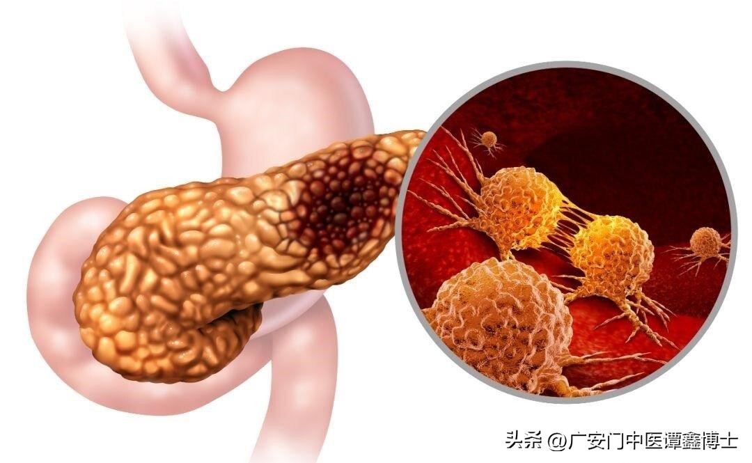癌症之王胰腺癌能活多长时间,为什么说胰腺癌是癌症之王