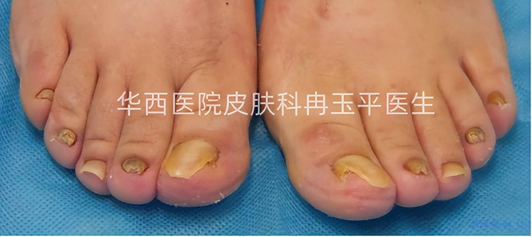 得了灰指甲是指甲变灰吗,灰指甲增厚变黑是灰指甲吗