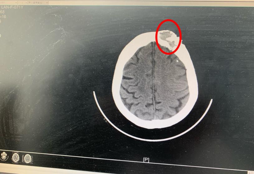 女子额头长包一查竟是肿瘤,额头长个包说是肿瘤