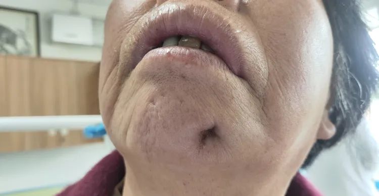 下巴有一个洞可以挤出脓,下巴上挤出黄色颗粒留下一个洞