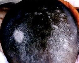 4岁儿童突然脱发严重是怎么回事,4岁儿童脱发严重该怎么办