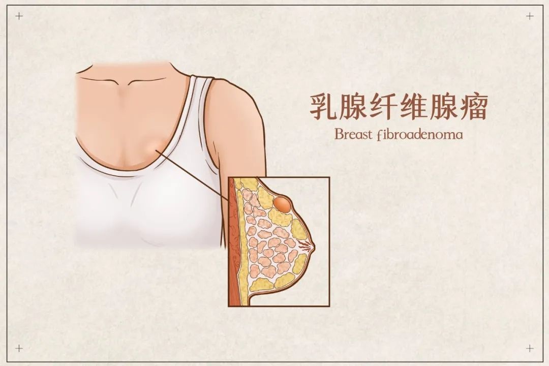 乳腺结节自查,自查乳腺结节的方法及技巧