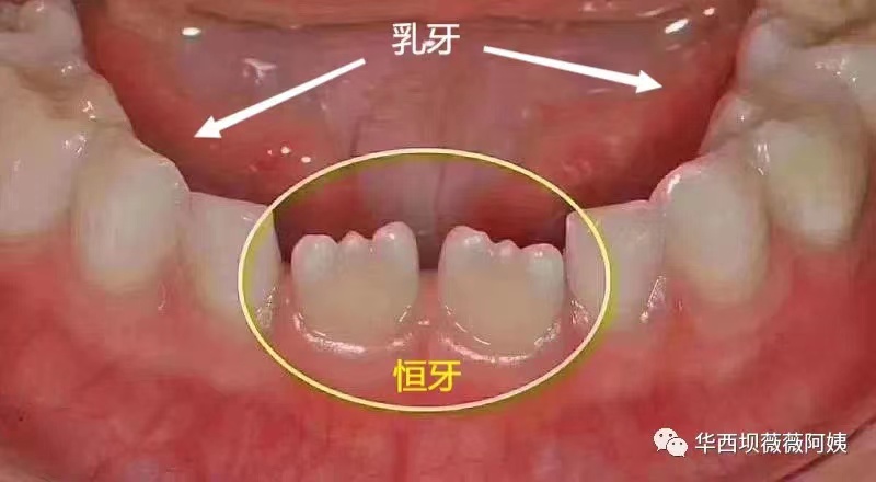 儿童早期牙齿矫正华西,华西口腔小孩矫正牙齿是什么科