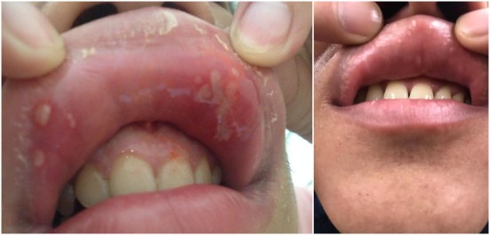 口腔溃疡反复发作，是缺维生素了？你可能一直都错了！改善口腔疾病，这个方法效果好