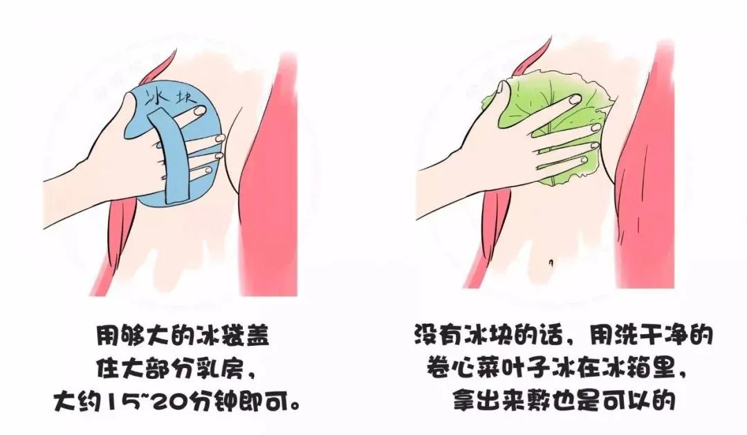 宝妈得乳腺炎怎样治疗,宝妈得了乳腺炎最快的治疗办法