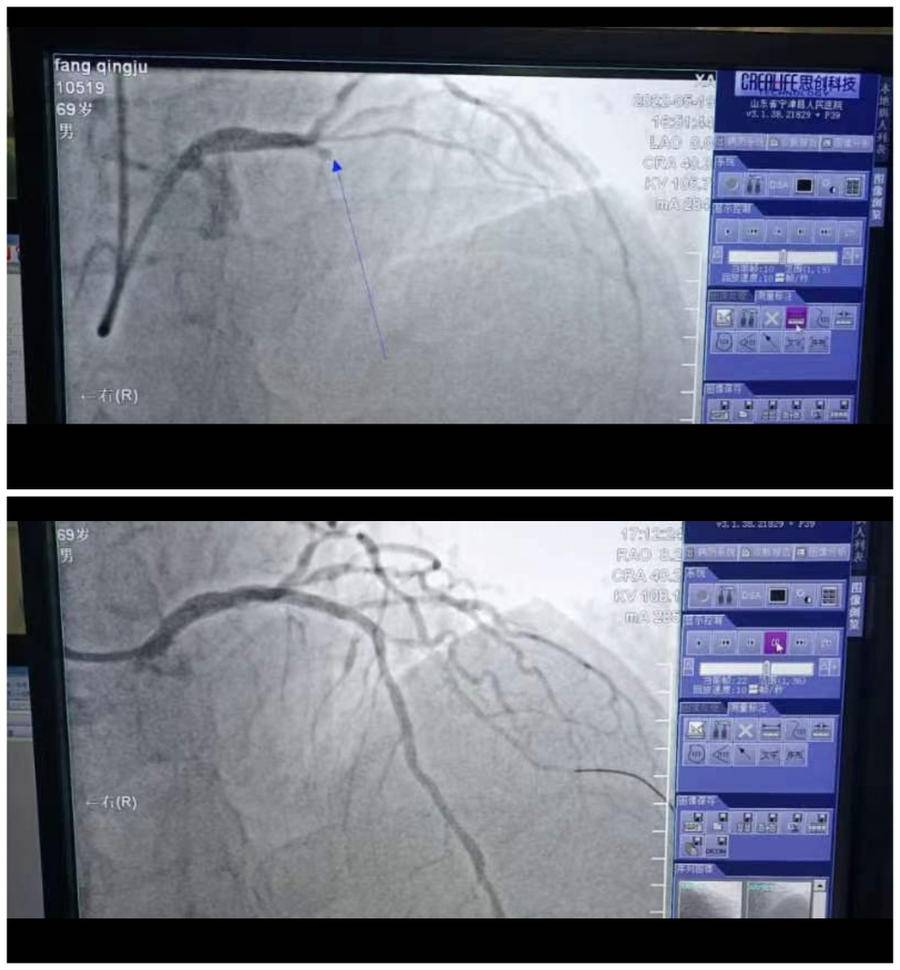 神奇！德州老刘吃西红柿后肚子疼，医生却为他植入了心脏支架…