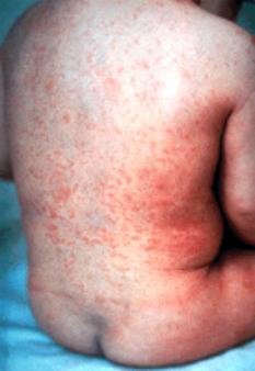 儿童生疹子哪里红点多,怎么区分孩子起的各种疹子