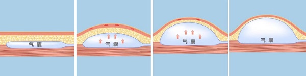 6毫米大的痣用什么方法去除,面部黑痣越来越大怎么办