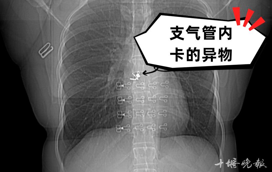 吃了小龙虾急救,吃了麻辣小龙虾呼吸困难