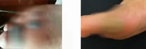 10岁男孩游泳班感染hpv,浙江一小男孩上游泳课感染hpv