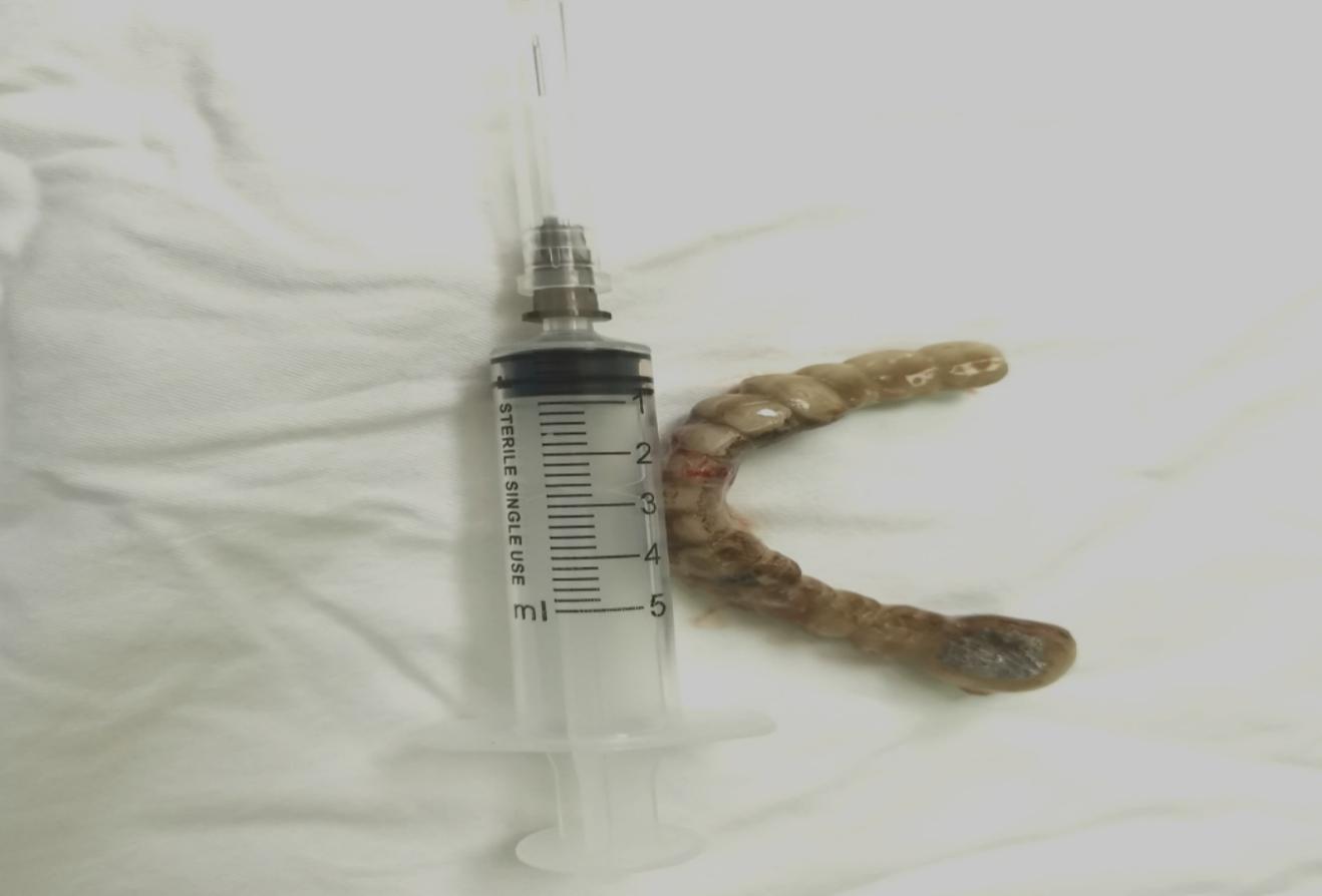 74岁老人误吞带钩假牙,老人误吞假牙怎么取出