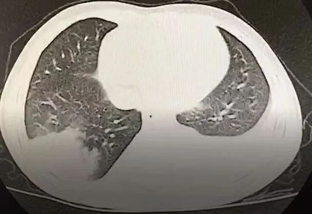 儿童感染肺炎链球菌得了中耳炎,儿童鼻窦炎引起中耳炎症状