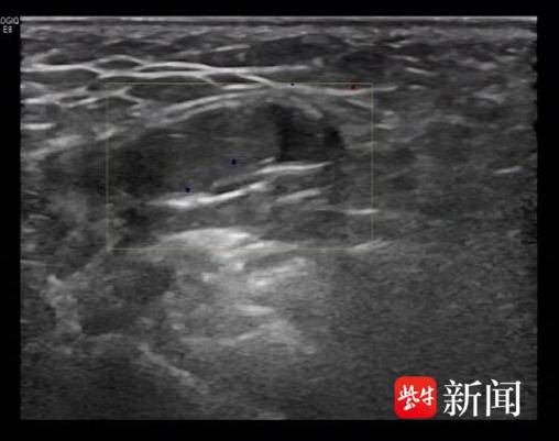 1岁男宝怎么“少个蛋蛋”？医生手术找回来了