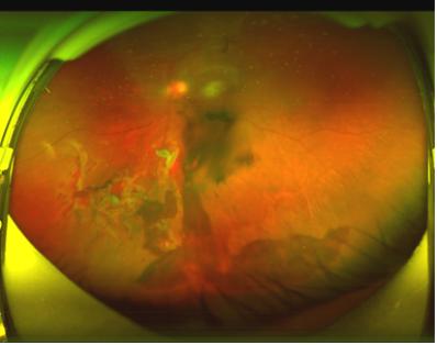 眼睛模糊散光可以针灸治疗吗,眼球失明康复手术