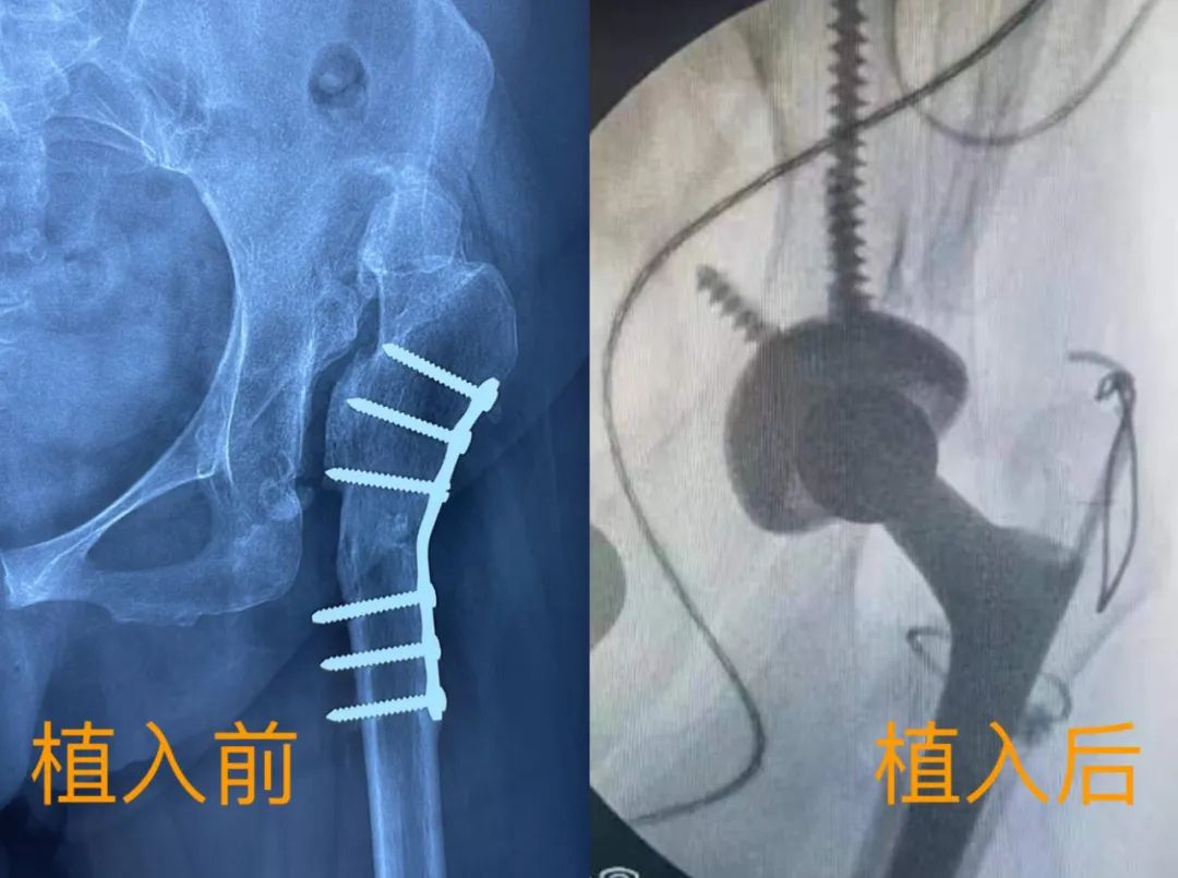 告别摇摆人生菏泽市牡丹人民医院枫叶正红院区成功治疗复杂先天性髋关节脱位
