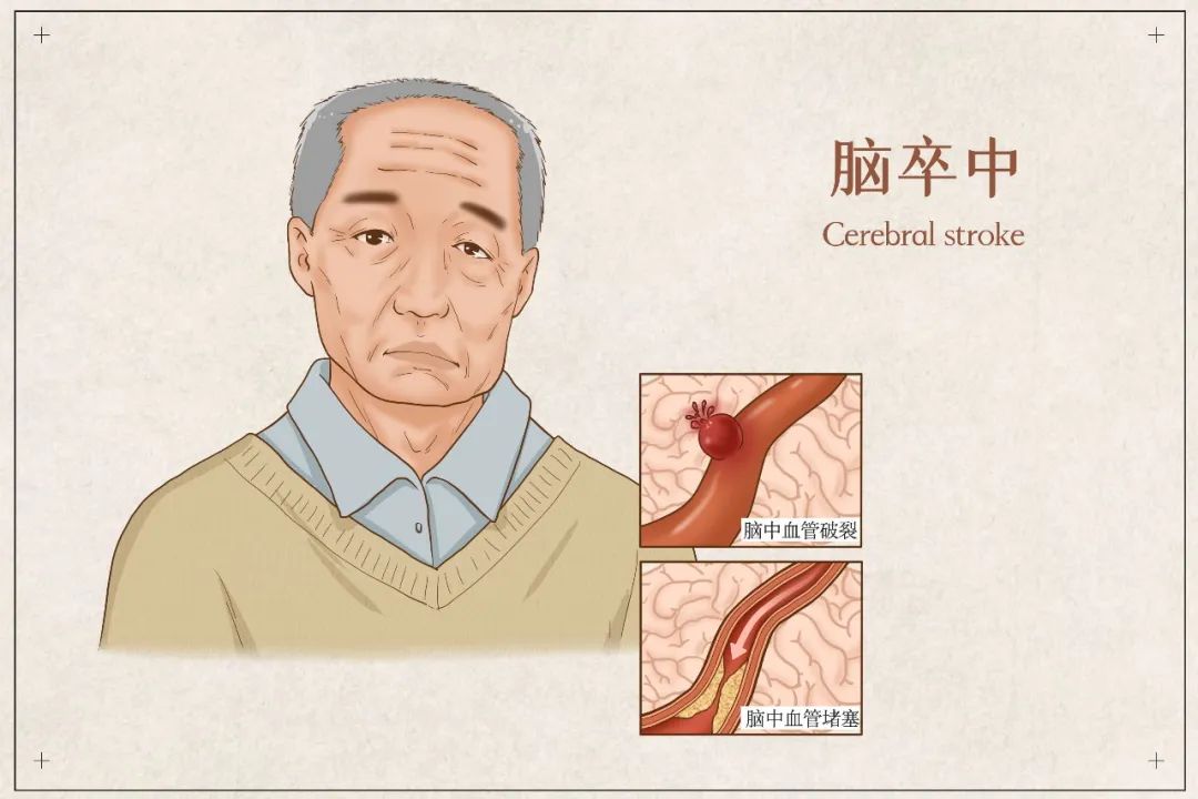 西安脑梗取栓康复医院,西安市第三医院脑卒中急救