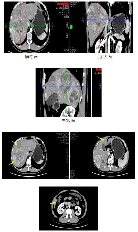 阳光融和医院普外一科顺利完成复杂巨大肝脏肿瘤切除术，为患者赢得生机